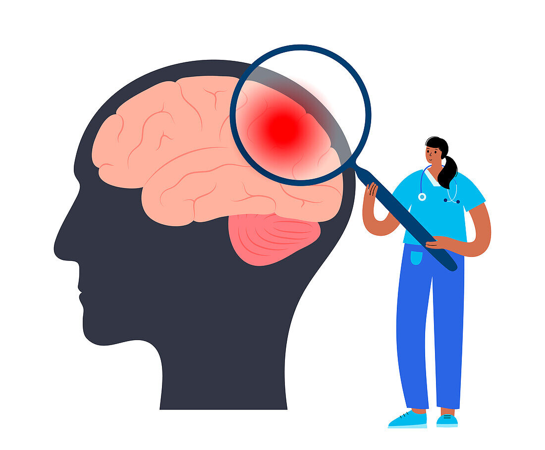 Stroke research, illustration