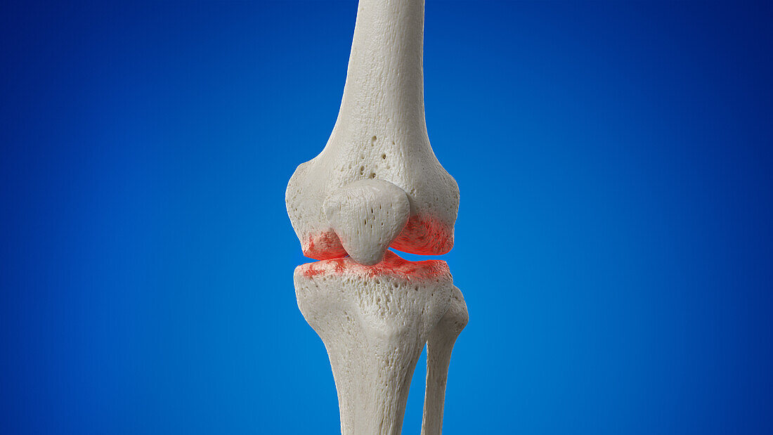 Arthritic joint, illustration