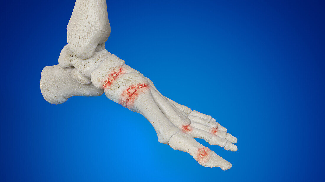 Arthritic foot, illustration