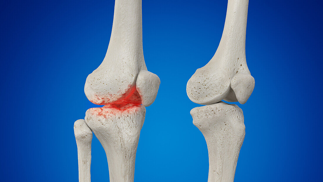 Arthritic knee joint, illustration