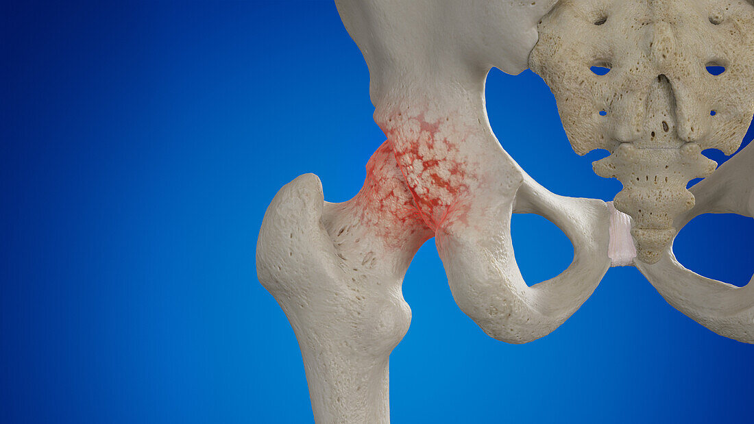 Arthritic hip joint, illustration