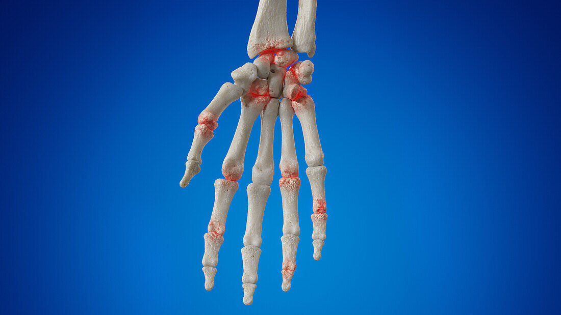 Arthritic hand, illustration