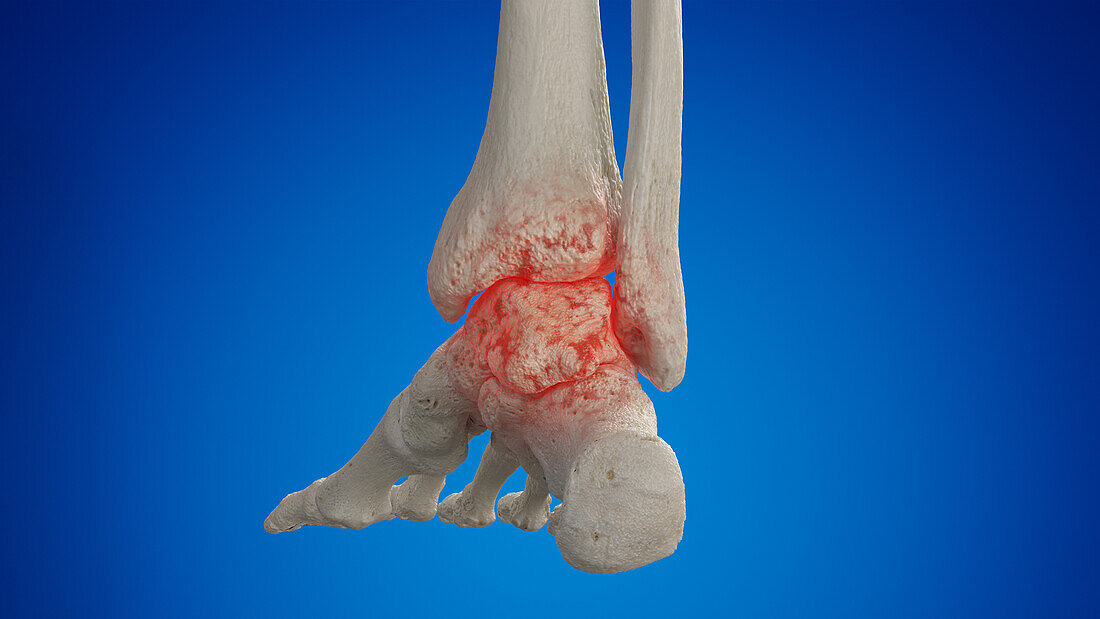 Arthritic ankle, illustration
