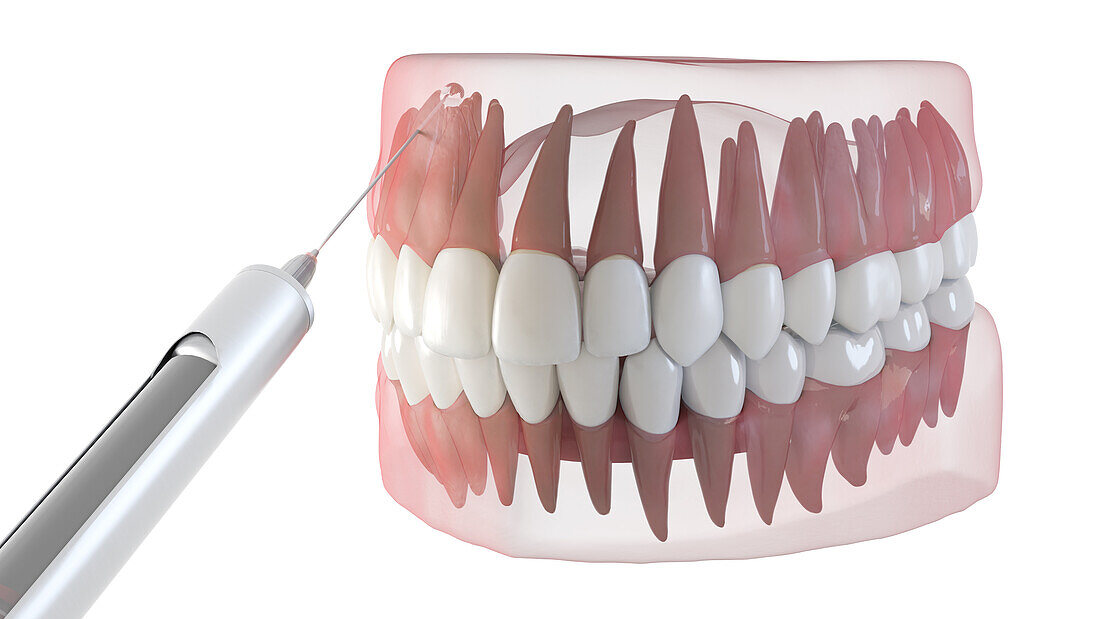 Dental anaesthesia, illustration