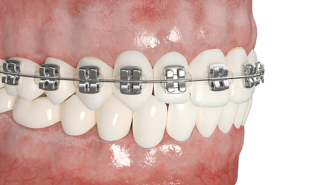 Dental braces, illustration