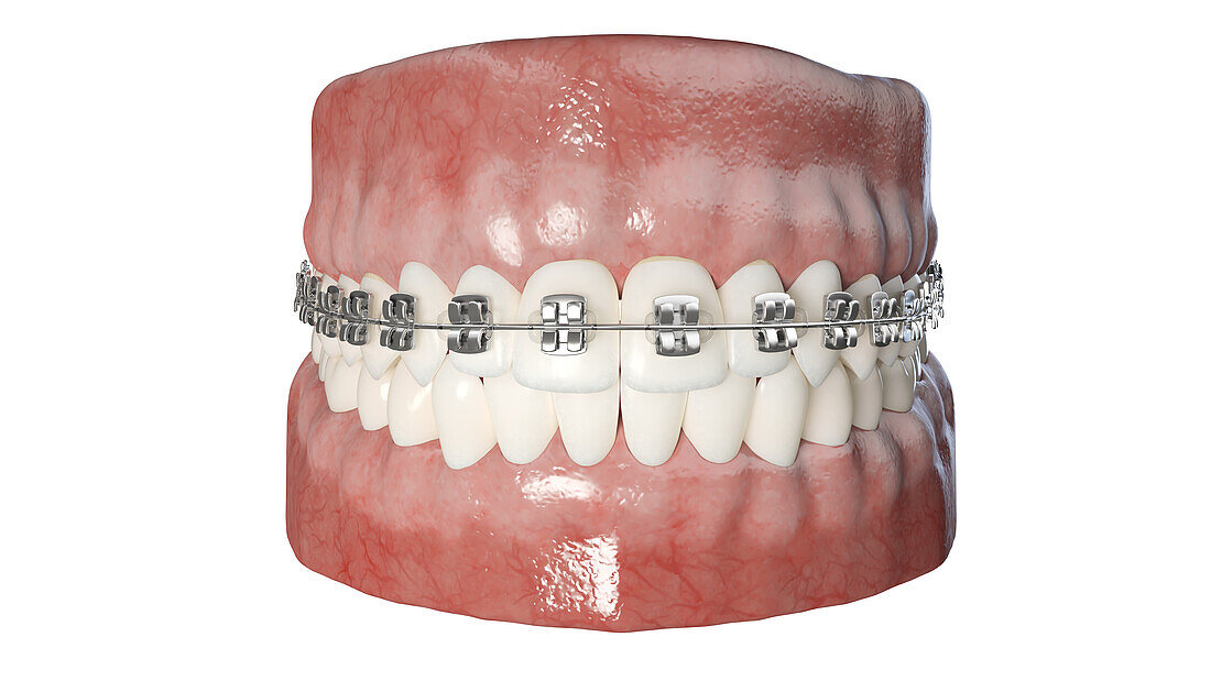 Dental braces, illustration