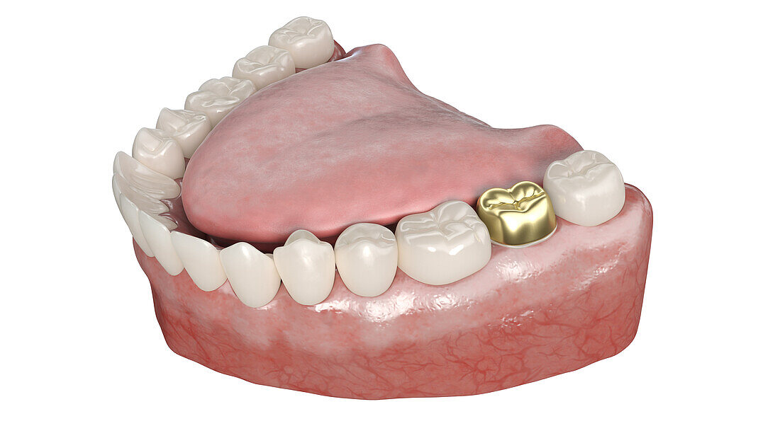 Dental crown, illustration