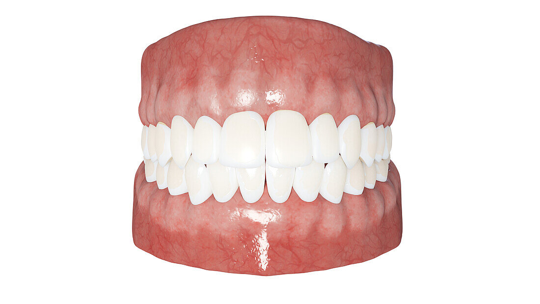 Dental demineralization, illustration