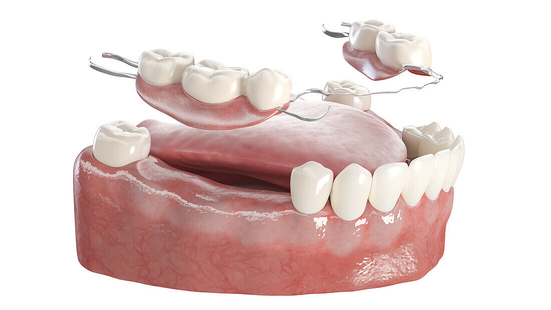 Dentures, illustration