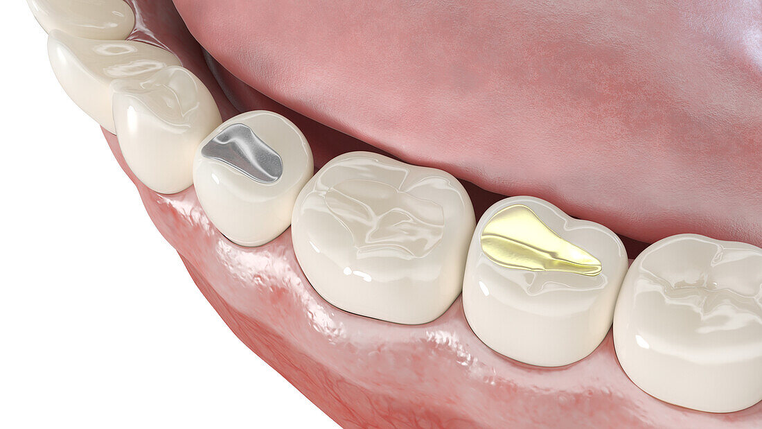 Different dental fillings, illustration