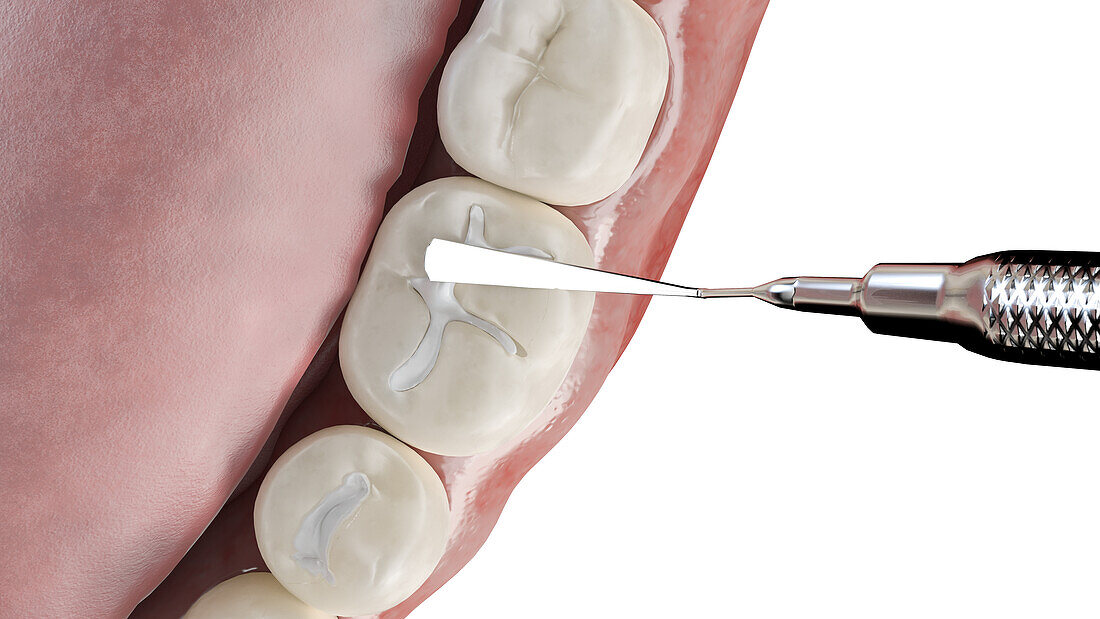 Dental fissure filling, illustration