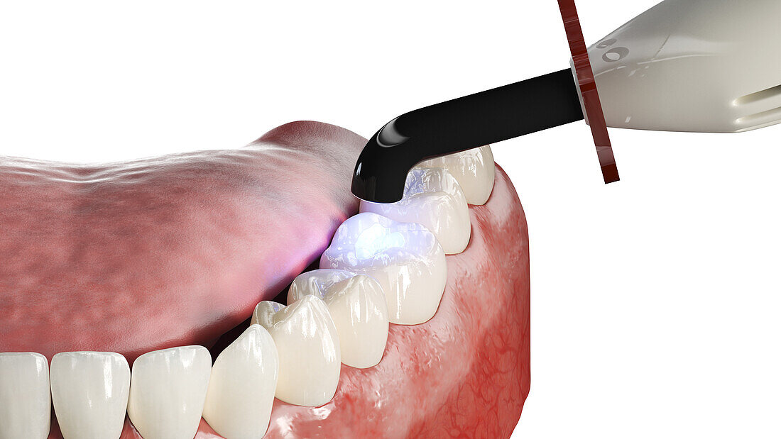 Dental polymerisation, illustration