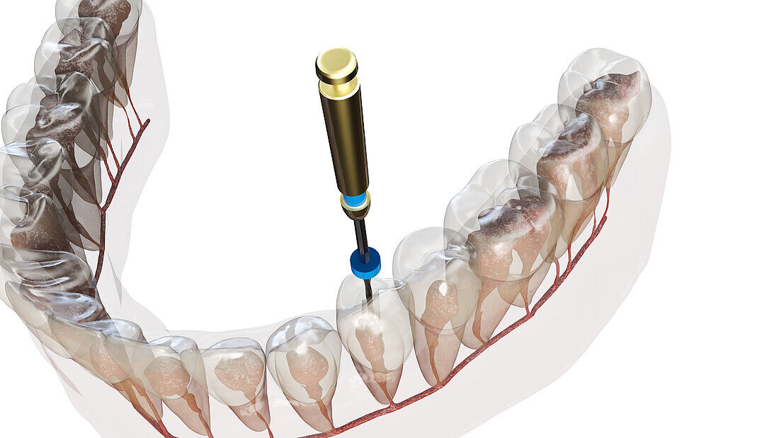 Root canal treatment, illustration