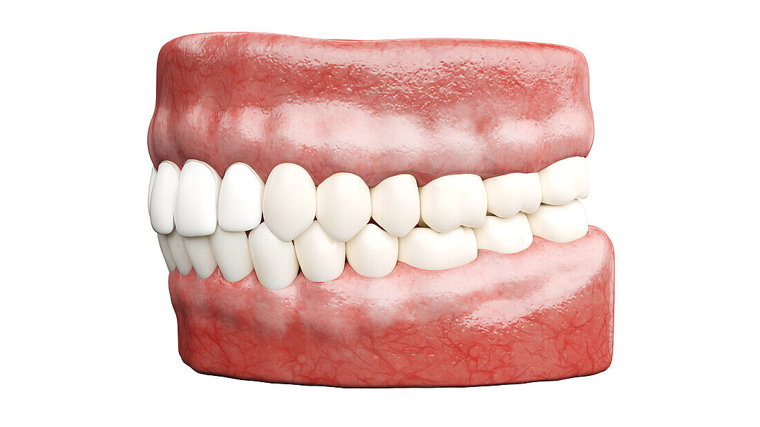 Dental veneers, illustration
