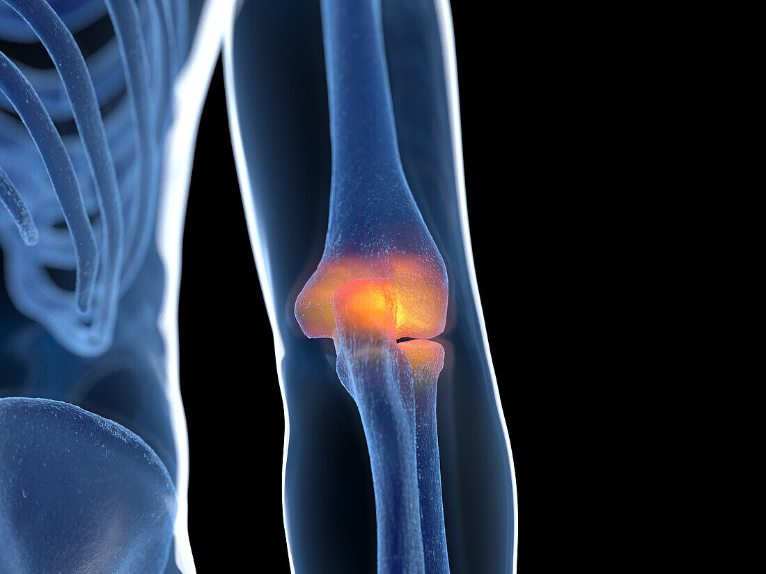 Inflamed elbow joint, illustration