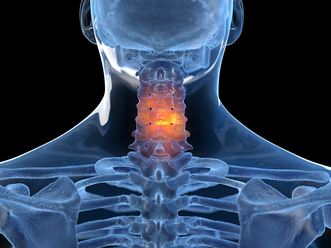 Inflamed neck, illustration