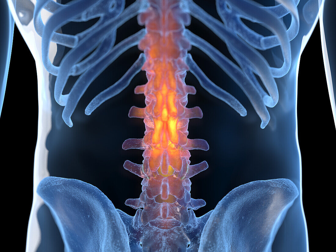 Inflamed back, illustration