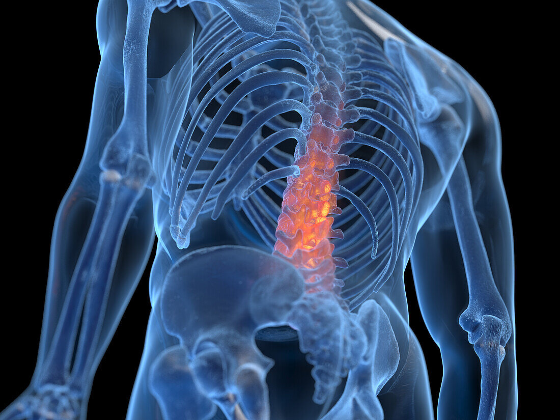 Inflamed back, illustration