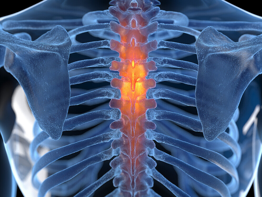 Painful thoracic spine, illustration