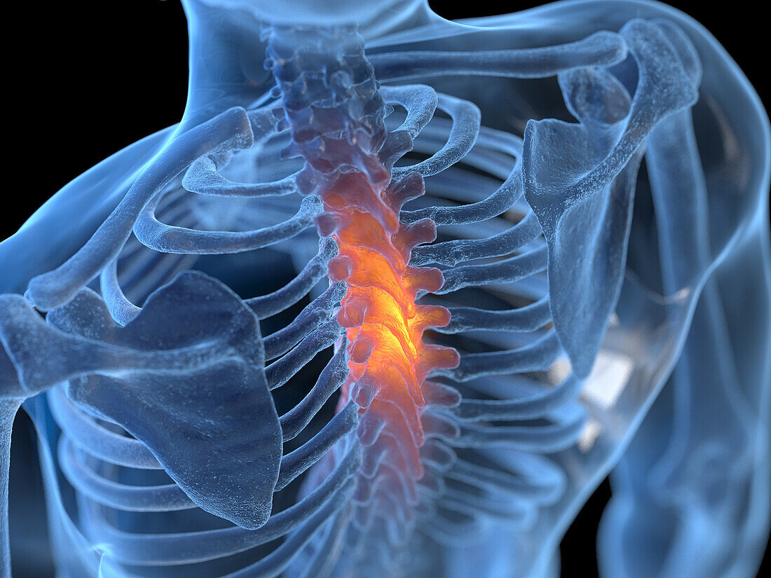 Painful thoracic spine, illustration