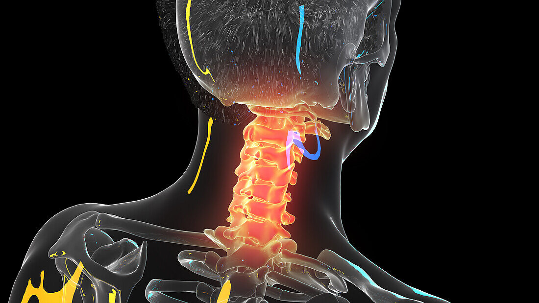 Painful cervical spine, illustration