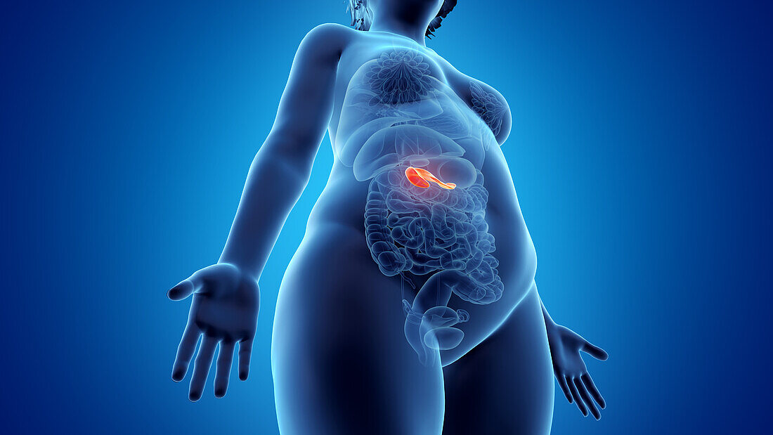 Obese woman's pancreas, illustration