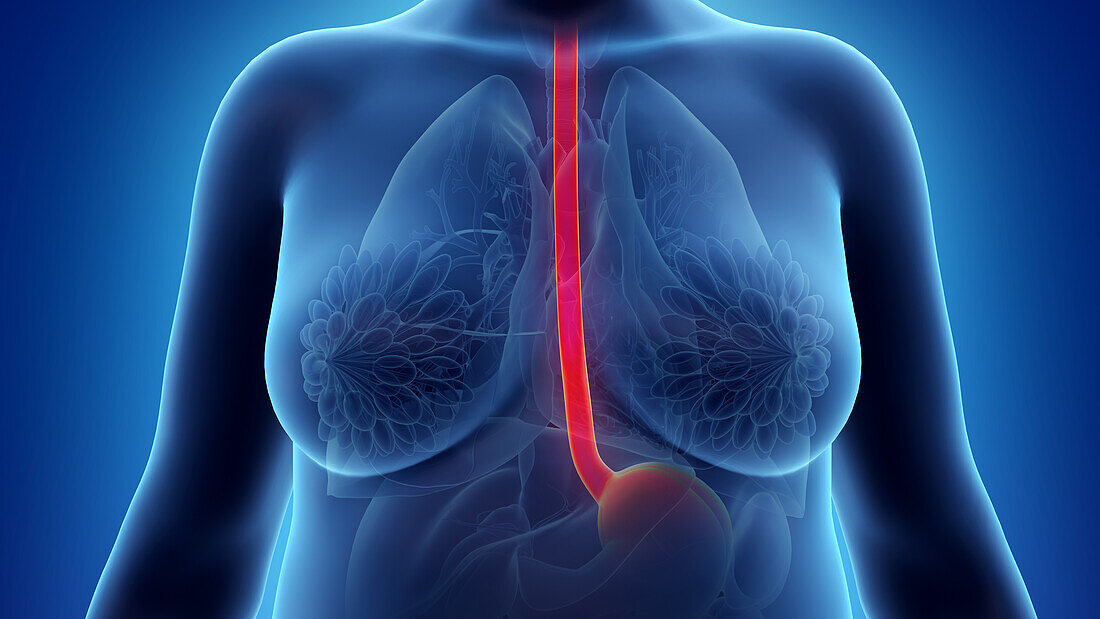 Obese woman's oesophagus, illustration