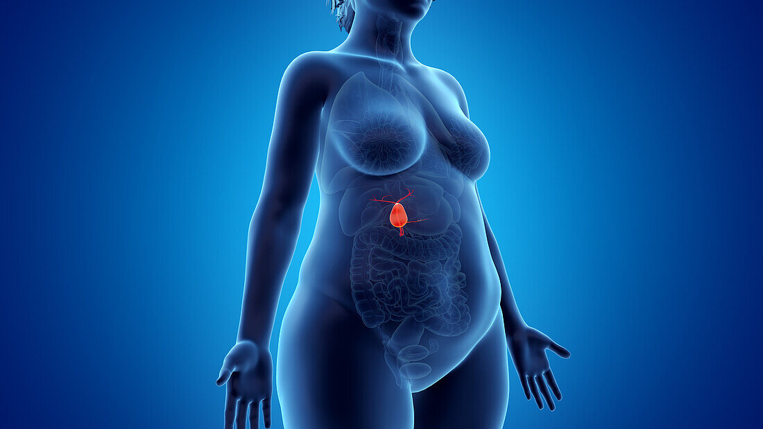 Obese woman's gallbladder, illustration