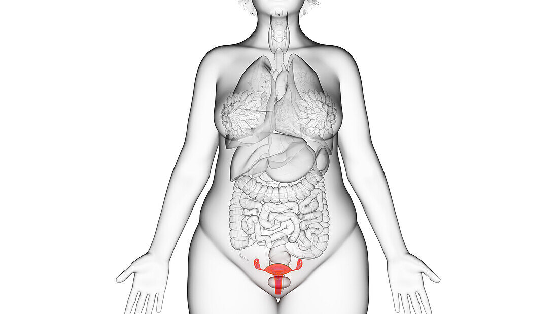 Obese woman's uterus, illustration