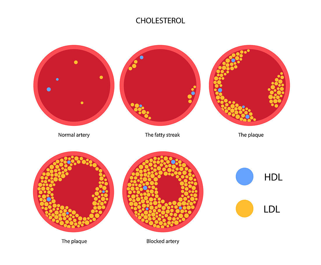 Cholesterol in human blood vessels, illustration