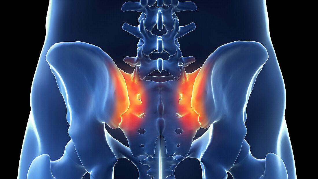 Painful sacroiliac joint, illustration
