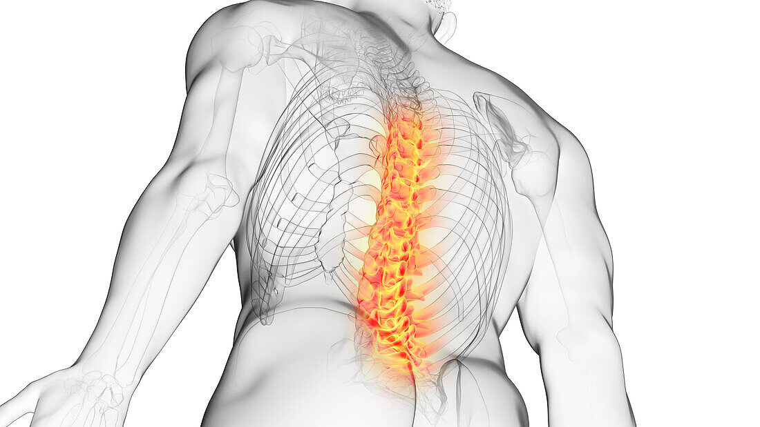 Painful spine, illustration