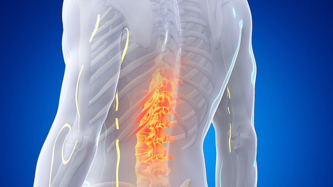 Painful spine, illustration