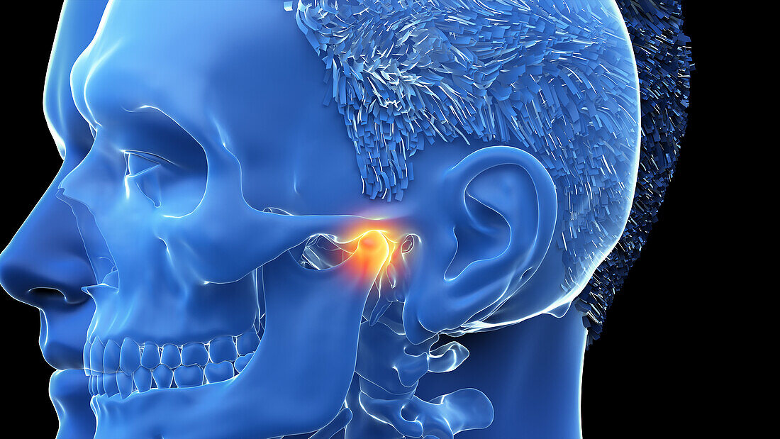 Painful temporomandibular joint, illustration