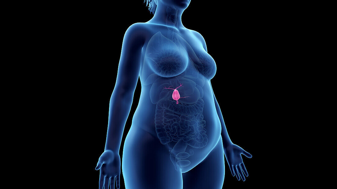 Obese woman's gallbladder, illustration