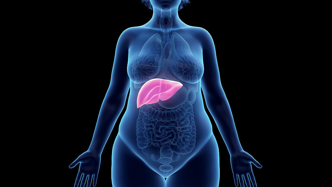 Obese woman's liver, illustration