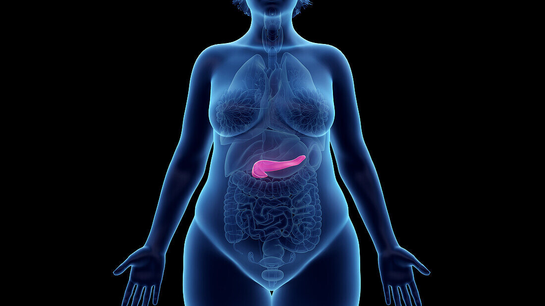Obese woman's pancreas, illustration