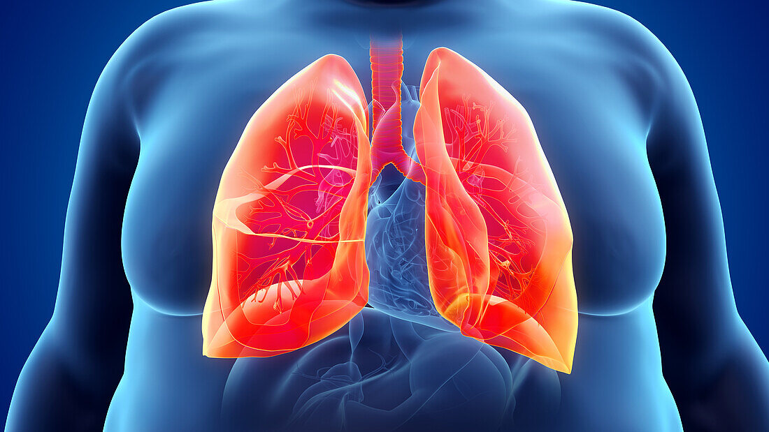 Obese man's lung, illustration