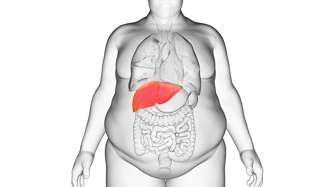 Obese man's liver, illustration
