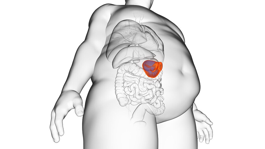 Obese man's spleen, illustration
