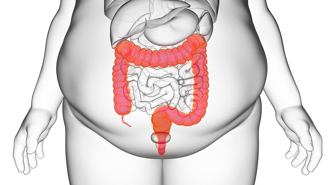 Obese man's colon, illustration