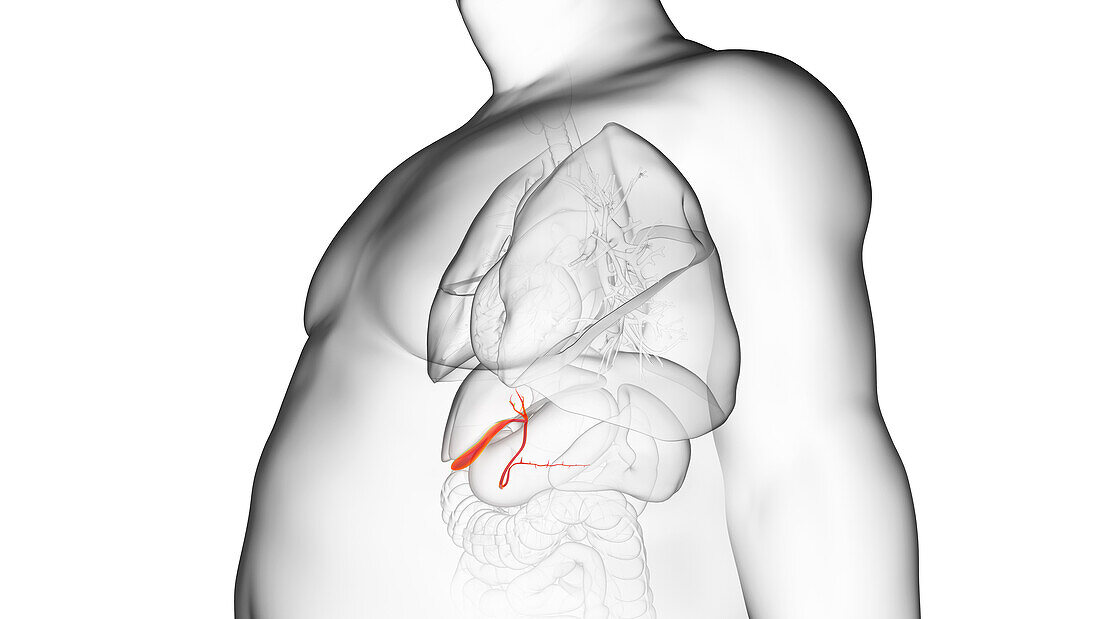 Obese man's gallbladder, illustration