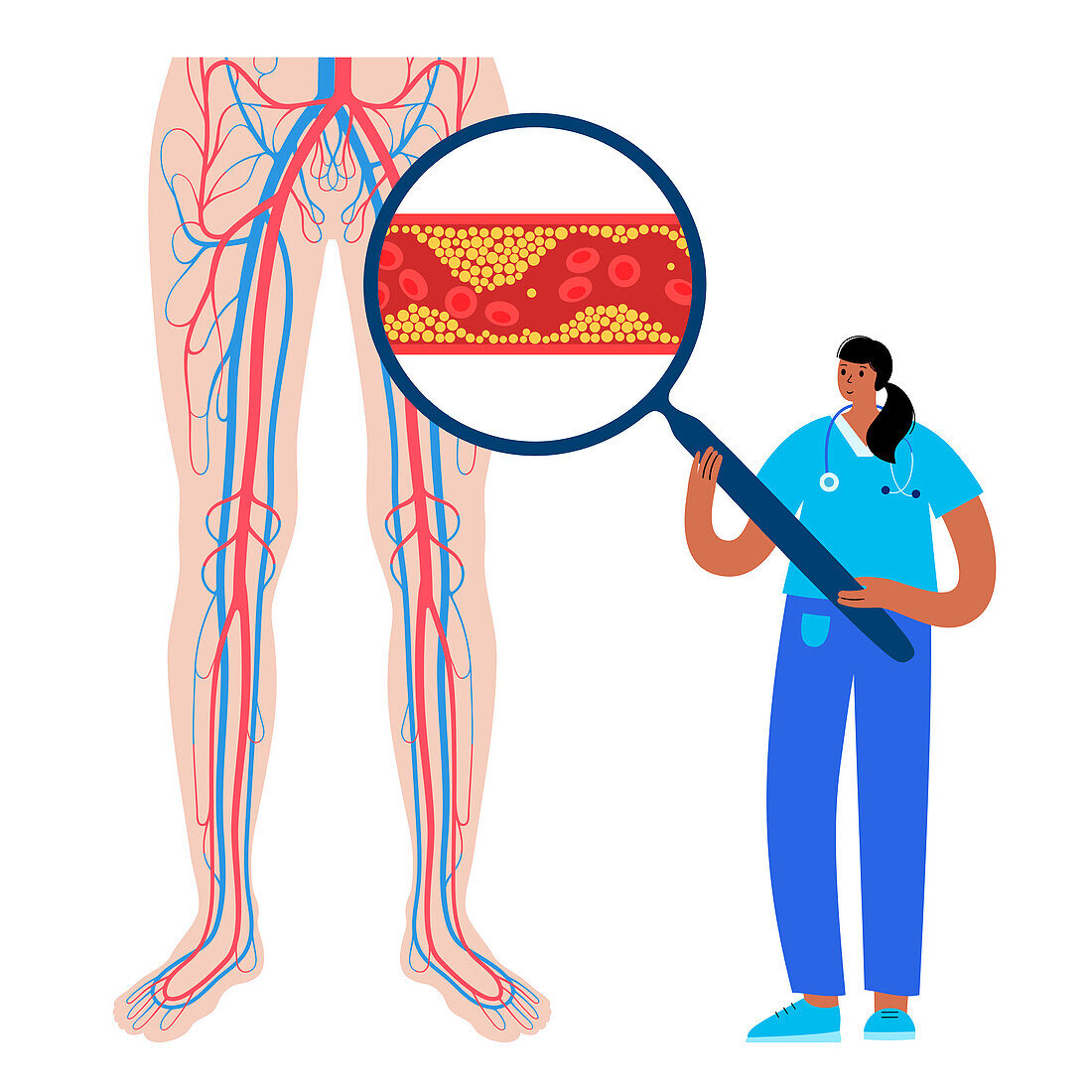 Peripheral artery disease, illustration