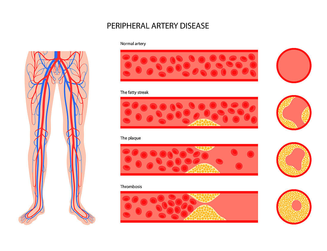 Peripheral artery disease, illustration