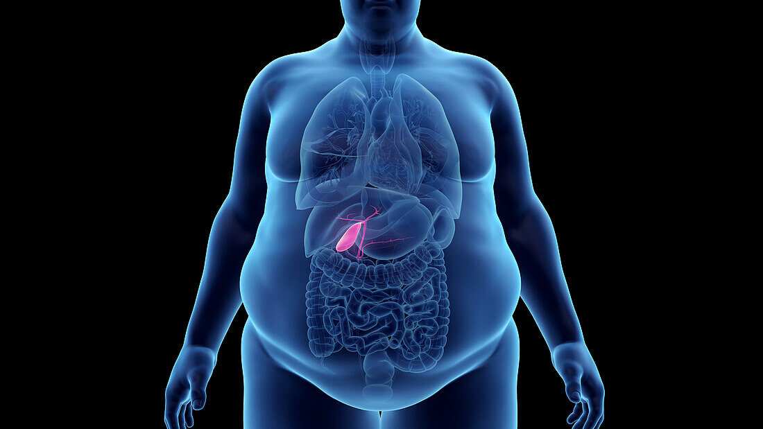 Obese man's gallbladder, illustration