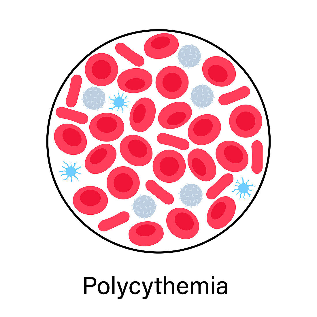 Polycythaemia, illustration