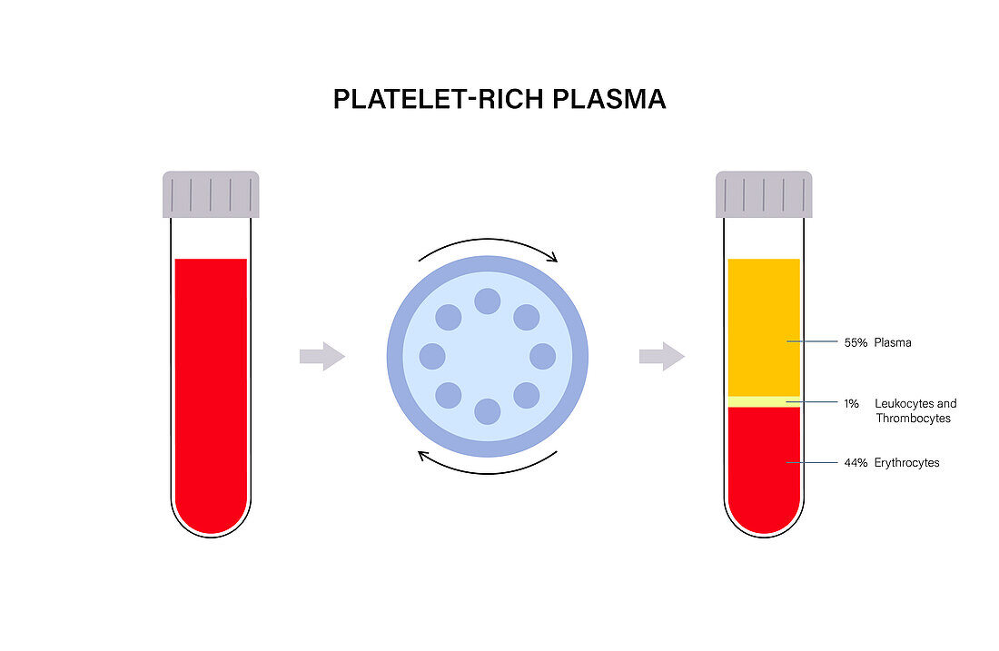 Platelet rich plasma preparation, illustration