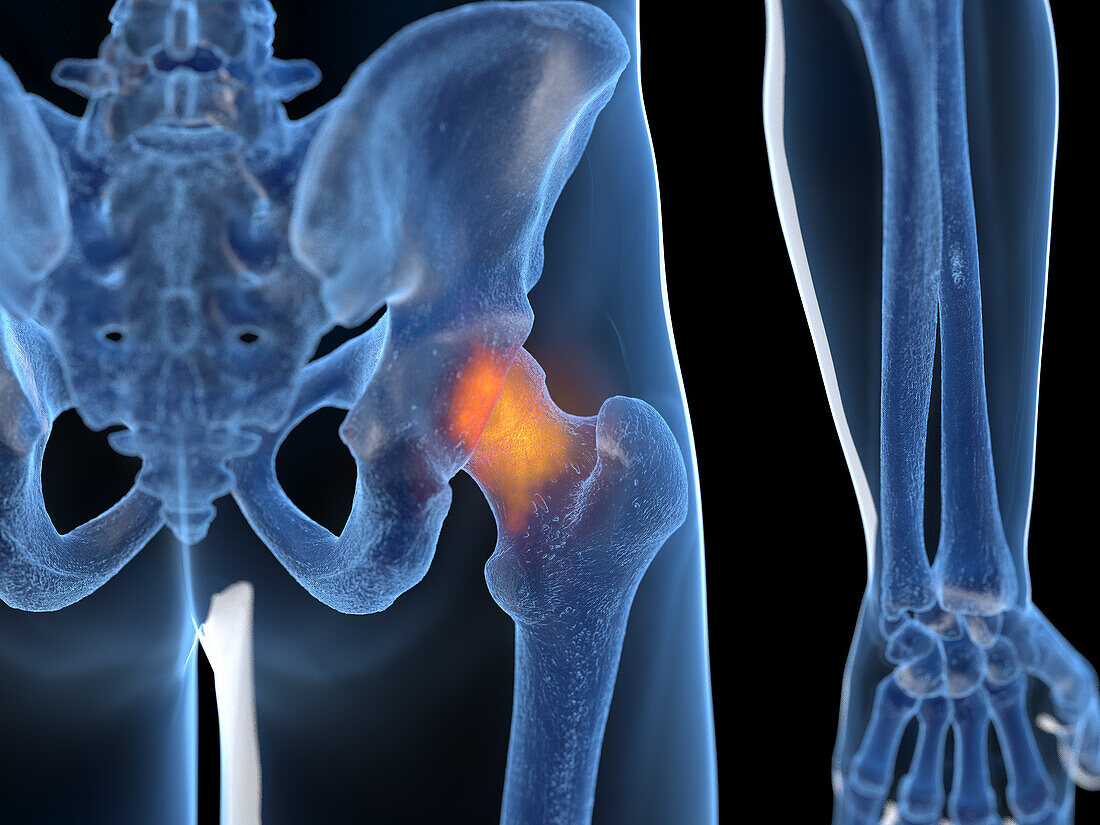 Inflamed hip joint, illustration