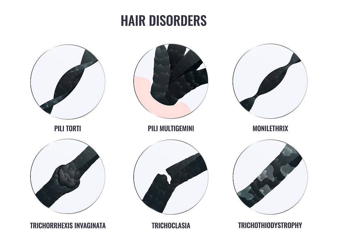 Hair disorder types, illustration