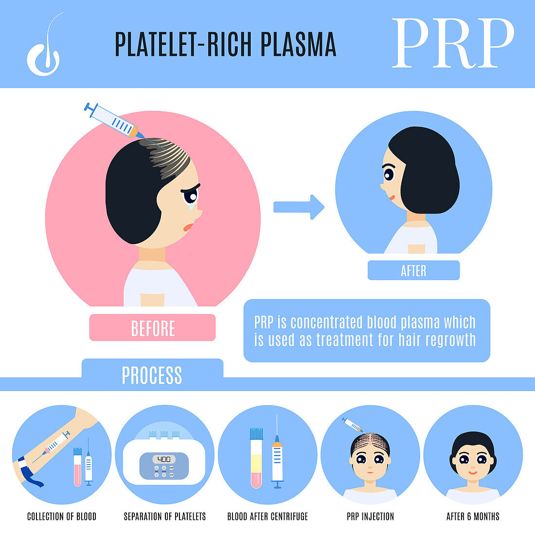 PRP hair loss treatment in women, illustration